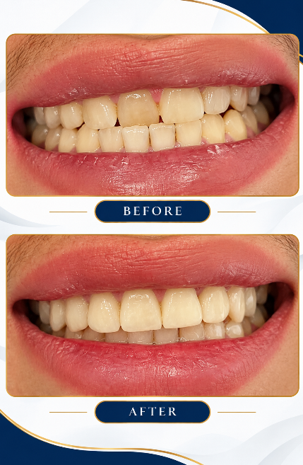 Teeth whitening before and after result at House Of Dentistry Dehradun